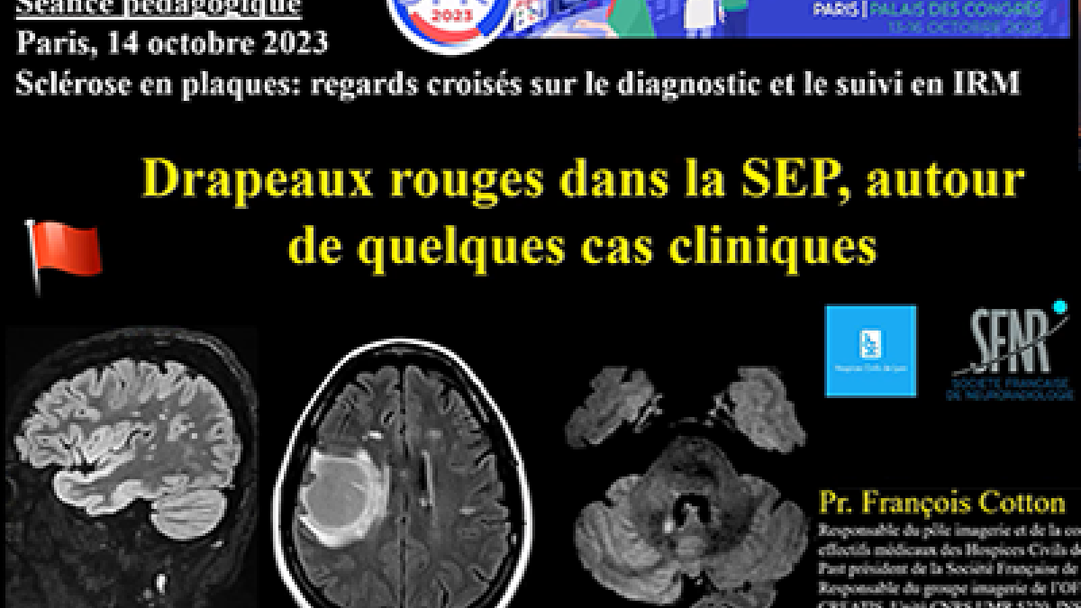 IRM et SEP Le duo de choc pour un diagnostic et un suivi pleins de rebondissements ! SFR